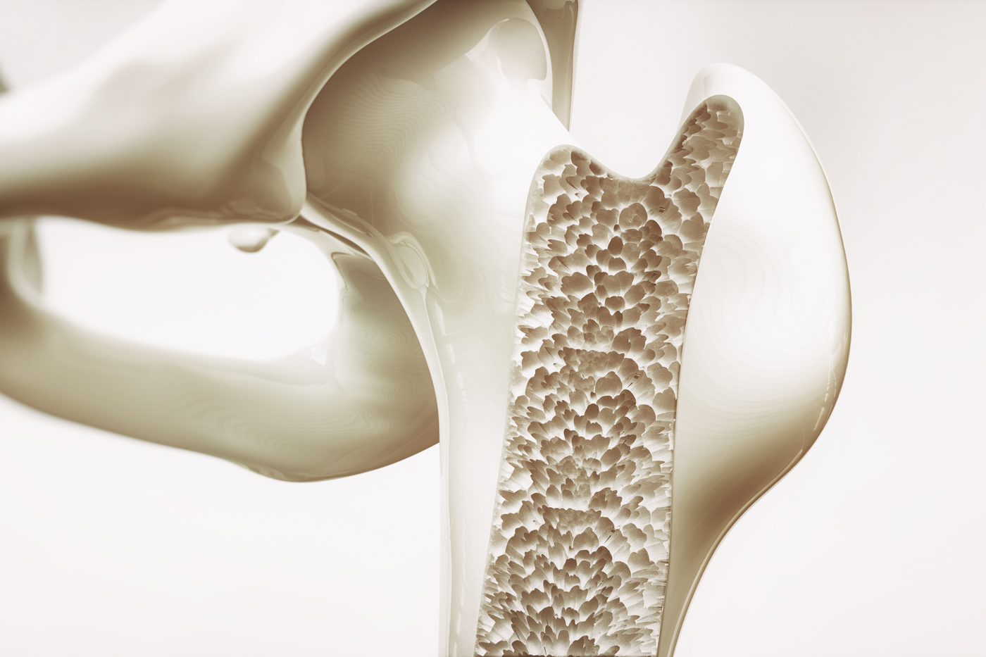Darstellung einer Osteoporose im Gelenk